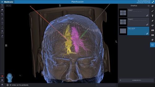 Neurocirugia_dolor_neuropàtic