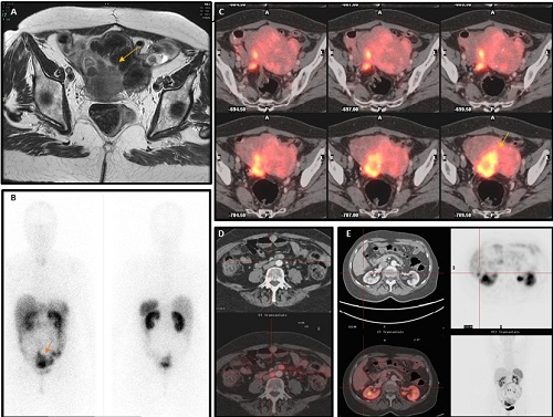 Tumors_neuroendocrins