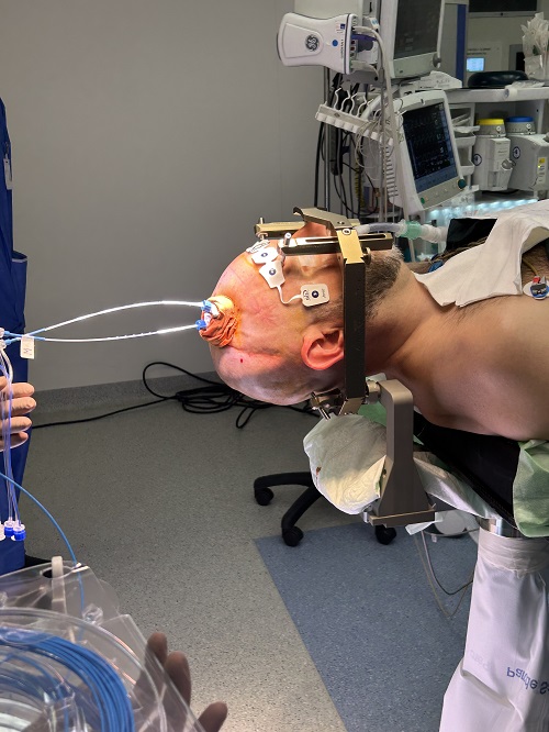 Neurocirurgia_glioblastoma