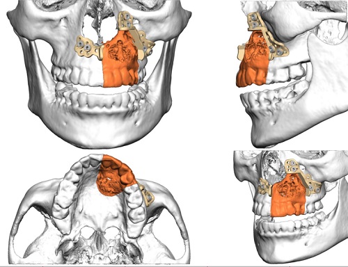 Planificació_Cirurgia_Maxil·lofacial